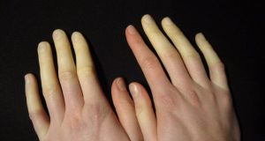 raynaud. 768x500